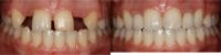 25-34 year old woman treated with Dental Implants