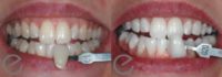 25-34 year old man treated with Teeth Whitening