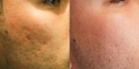 25-34 year old man treated with Microneedling RF