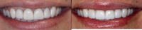 25-34 year old woman treated with Porcelain Veneers