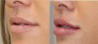 25-34 year old woman treated with Juvederm Lip Augmentation