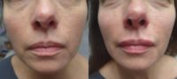 35-44 year old woman treated with Restylane Lyft and Resylane Silk