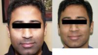 35-44 year old man treated with Laser Hair Removal to lighten beard
