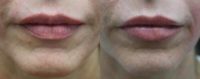 35-44 year old woman treated with Restylane Refyne