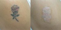 35-44 year old woman treated with Tattoo Removal