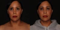 35-44 year old woman treated with Nonsurgical Facelift, Renuvion, Laser Liposuction