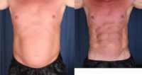 45-54 year old man treated with Laser Liposuction