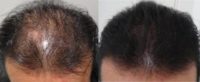 45-54 year old man treated with Scalp Micropigmentation