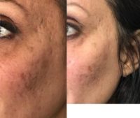 45-54 year old woman treated with PRP Injections and microneedling with SkinPen