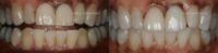 55-64 year old woman treated with Dental Implants