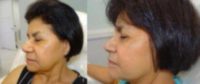 55-64 year old woman treated with Liquid Facelift