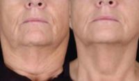 55-64 year old woman treated with Microneedling RF
