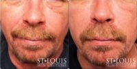 55-64 year old man treated with Injectable Fillers