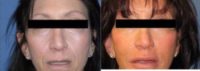 55-64 year old woman treated with Injectable Fillers and botox