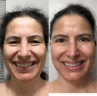 55-64 year old woman treated with Cheek Fillers, Botox