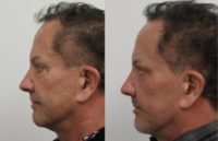 65-74 year old man treated with Laser Resurfacing