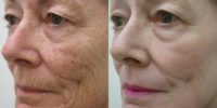 65-74 year old woman treated with a deep Chemical Peel