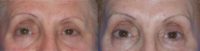 Correction of uneven brows with Botox