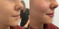 Natural Lip Enhancement with Filler - 26 year old woman treated with RHA2