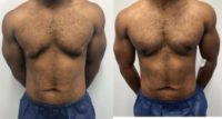 18-24 year old man treated with Smart Lipo