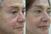 65-74 year old woman treated with Chemical Peel