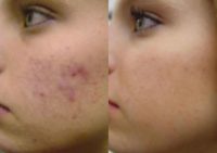 17 or under year old woman treated with Microneedling RF