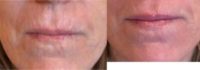 Lip lines treated with Microtox