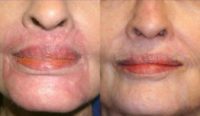 65-74 year old woman treated with Scar Removal