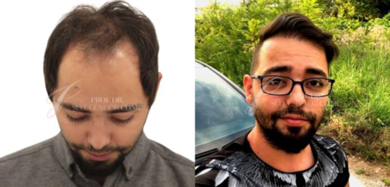 25-34 year old man treated with Hair Transplant, FUE Hair Transplant, Hair Loss Treatment