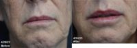 55-64 year old woman treated with Lip Fillers, Juvederm