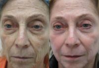 65-74 year old woman treated with Chemical Peel