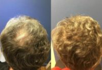 55-64 year old man treated with PRP for Hair Loss