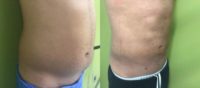 25-34 year old man treated with Tickle Lipo