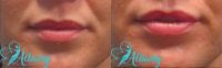 25-34 year old woman treated with Injectable Fillers to enhance the natural look of her lips