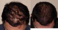 45-54 year old man treated with Hair Loss Treatment