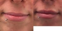 25-34 year old woman treated with Injectable Fillers for Lips