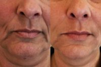 55-64 year old woman treated with Dermal Fillers