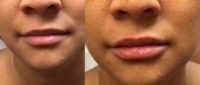 25-34 year old woman treated with Juvederm for lip enhancement