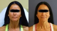 Woman treated with Botox, Dermal Fillers, Fractora RF, Microdermabrasion