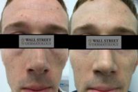 25-34 year old man treated with Restylane