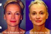 55-64 year old woman treated with Facial Enhancements