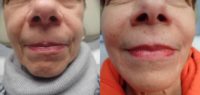 65-74 year old woman treated with Restylane Lyft, Juvederm, and Botox for facial rejuvenation