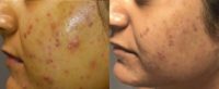 35-44 year old woman treated with Chemical Peel