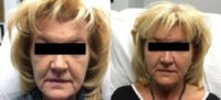 55-64 year old woman treated with Bellafill