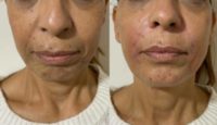 65-74 year old woman treated with Cheek Fillers, Chin Fllers, Nasolabial filler