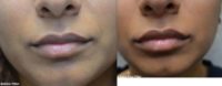 35-44 year old woman treated with Lip Fillers, Juvederm