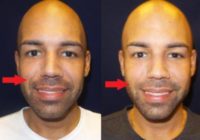 25-34 year old man treated with Juvederm