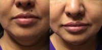 35-44 year old woman treated with Juvederm