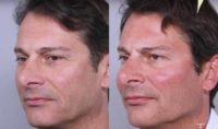 35-44 year old man treated with Injectable Fillers, Cheek and Chin Fillers