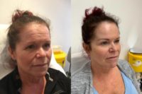 45-54 year old woman treated with Nonsurgical Facelift